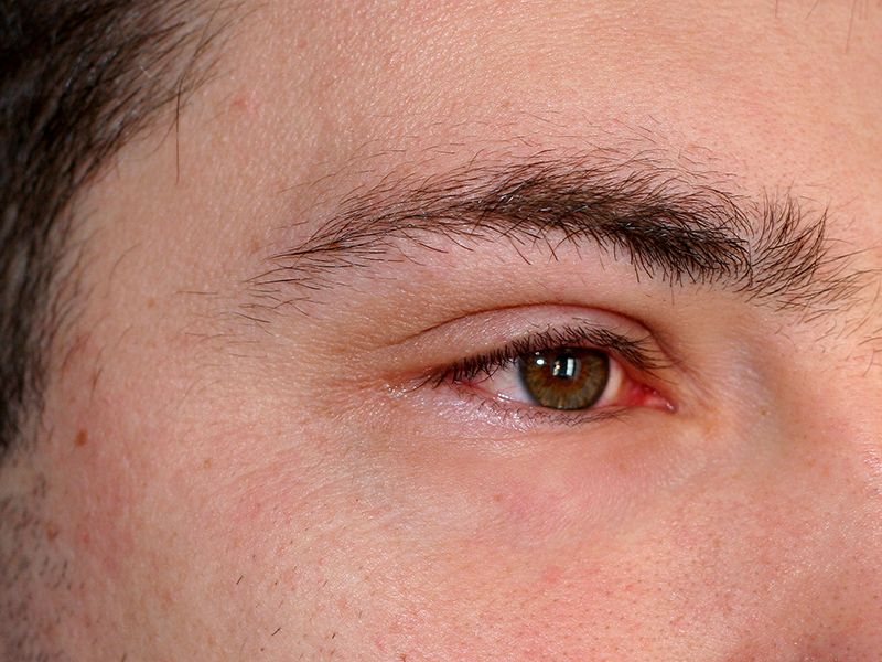 En cas d'inflammation oculaire, les yeux sont rouges, gonflés et peuvent couler. Souvent, les paupières sont collées.